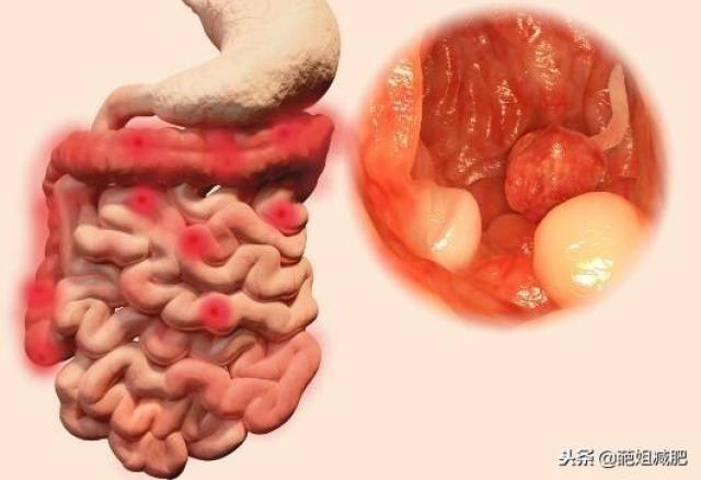 医生直言:直肠癌早发现治愈率越高,五个健康习惯可降低肠癌风险