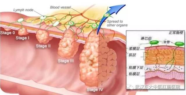 但结直肠癌是长在结直肠粘膜上的,在相对较早期就可能通过粪便发现