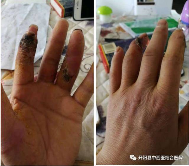 开阳县中西医结合医院成功实施首例断指再植术