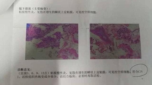 通俗点说就是,挖空细胞大都是由hpv病毒感染导致的鳞状上皮细胞发生