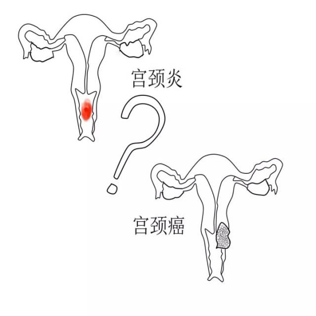 宫颈炎没有治疗一定会变成宫颈癌吗?