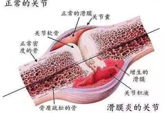 不明原因的膝关节肿胀,疼痛,需警惕滑膜炎在"作祟"