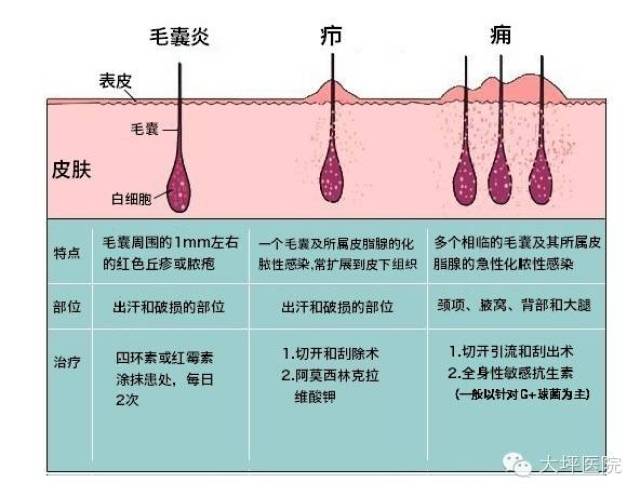 逐渐隆起高于皮肤,结节中央组织坏死,液化成浓,硬结顶端有黄白色脓栓