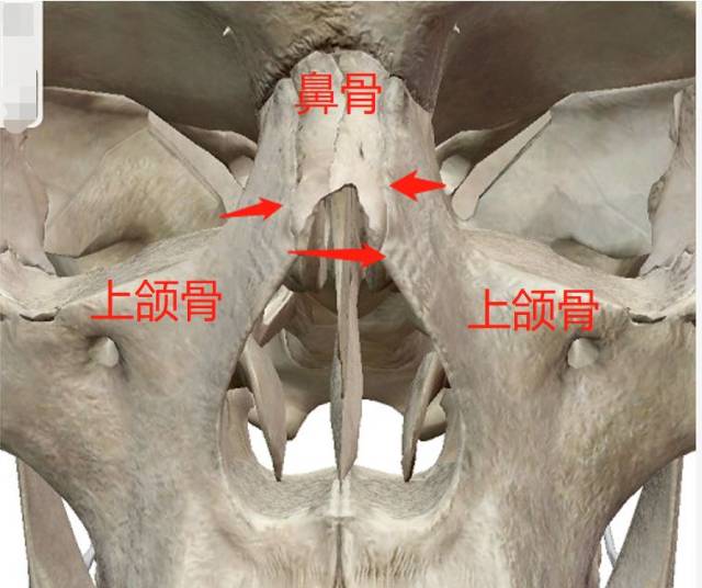 体现在人脸上就是下面这样,鼻骨和上颌骨的链接处形成的宽度过大.