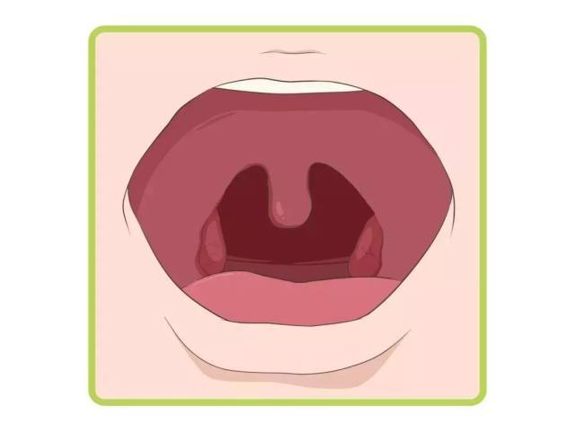 呼吸道系统 | 高烧,咽痛,化脓!宝宝扁桃体炎反复发作