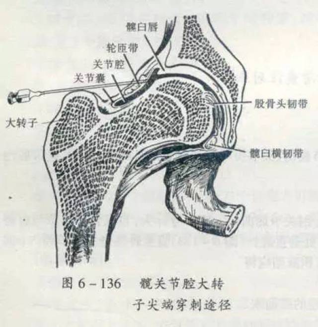 回抽无回血后,即可注射少量药液;再继续进针穿过关节囊进入关节腔