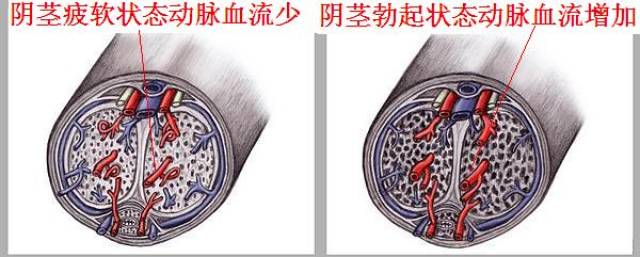 勃起功能障碍是由于血管内皮功能障碍,导致勃起时血管扩张不够,海绵体