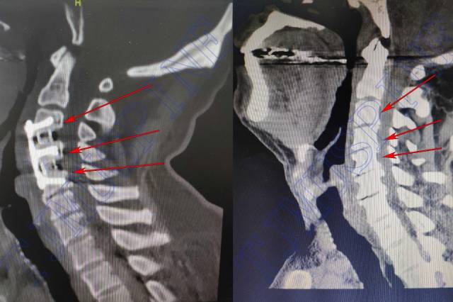 术后x线正侧位:→钛板及螺钉内固定 术前后x线侧位对比: 术后颈椎