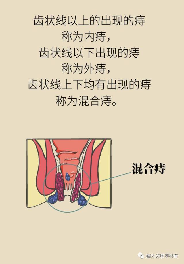 得了痔疮是一种什么样的体验?