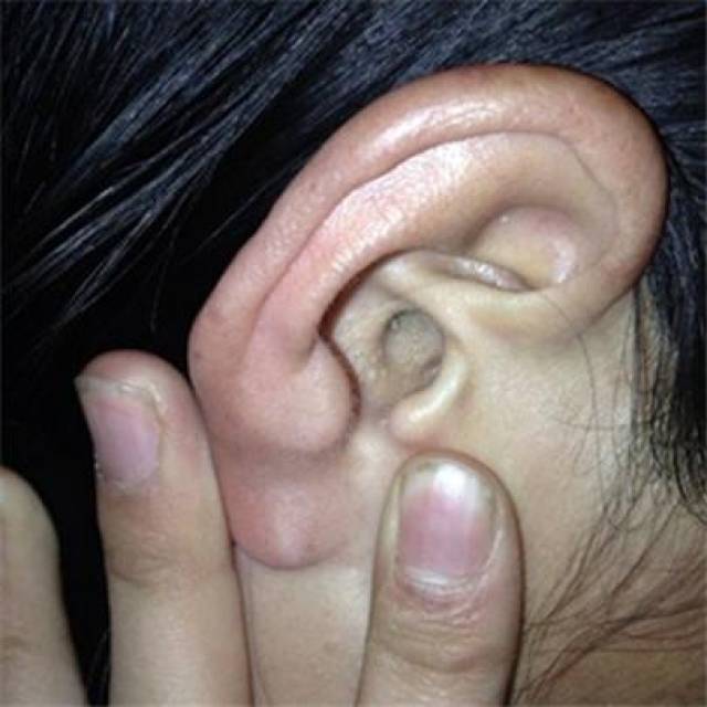 耳朵上长痘痘是什么原因?