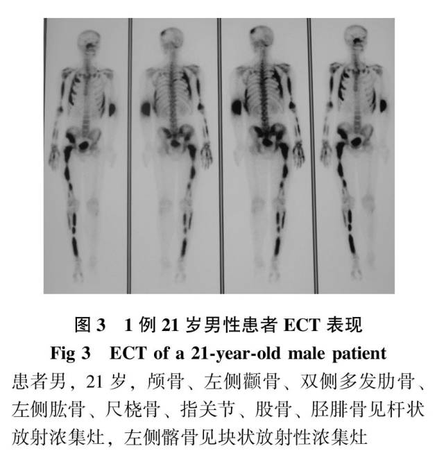 骨纤维结构不良临床特征及基因突变检测