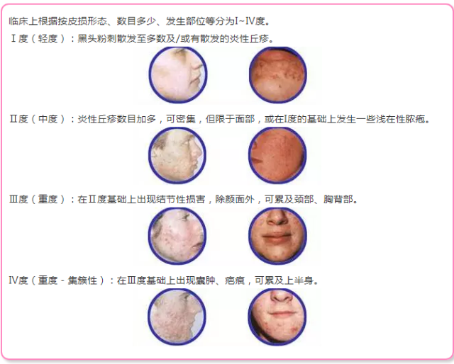 铂钰— 痘痘,粉刺,痤疮的成因,分级和对策