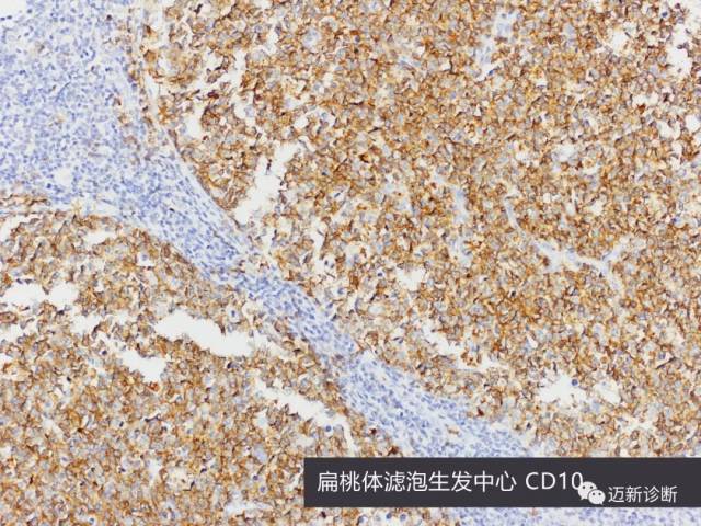 病理为何要做免疫组化之肾细胞癌实战篇