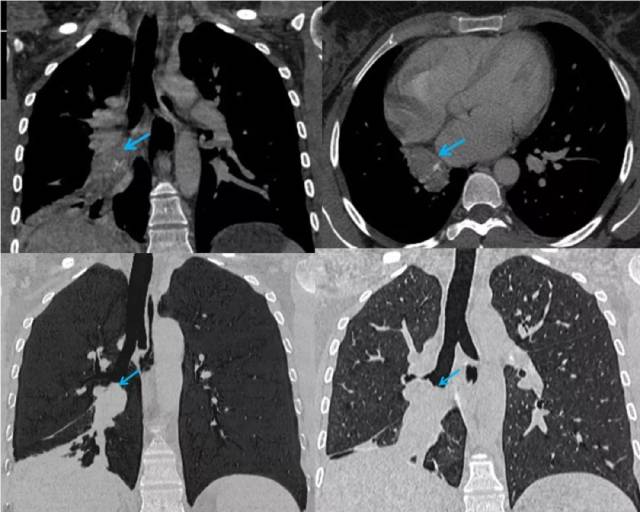 胸部支气管类癌肿瘤的影像学检查