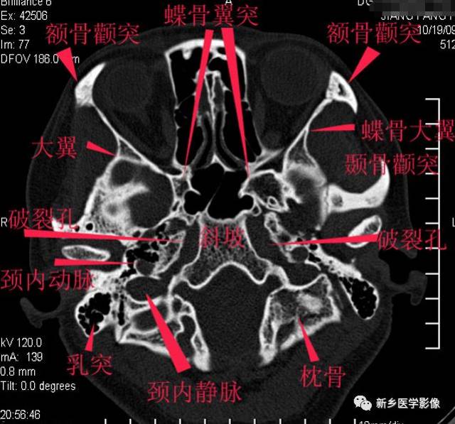 太赞了,纯手工详细标注颅底解剖