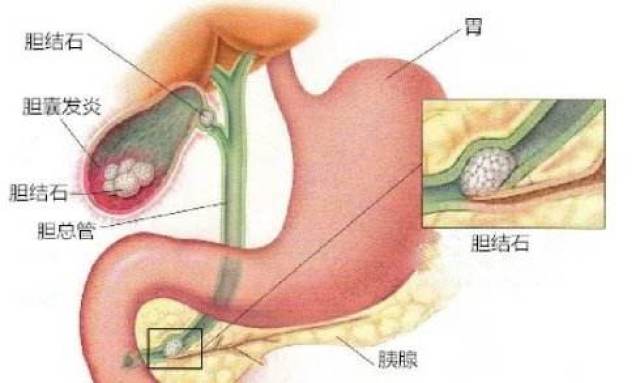 胆管结石必须切除吗/结石病中医院sell