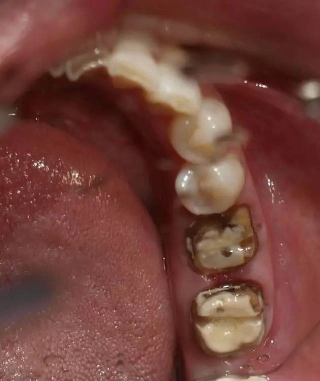 食物嵌塞简介及临床病例1例