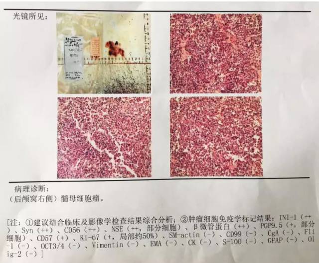 术后3天mri示: 肿瘤切除满意,肿瘤少量残留,小于1.