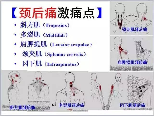 疼痛治疗必备的《全身激痛点手册》肌筋膜疼痛与功能障碍图文全解