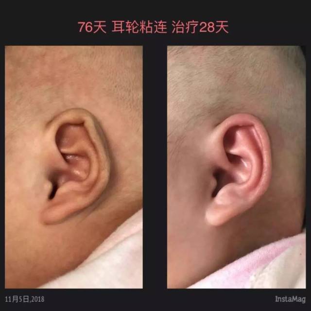 【妇儿科普】一招制服杯状耳