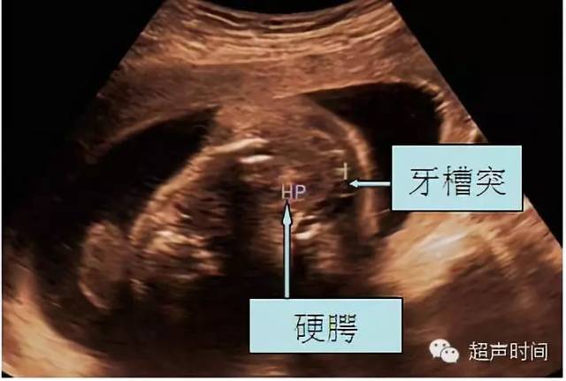 d,双侧完全性腭裂:裂隙在前颌骨部分,各向两侧斜裂,直达牙槽;鼻中隔