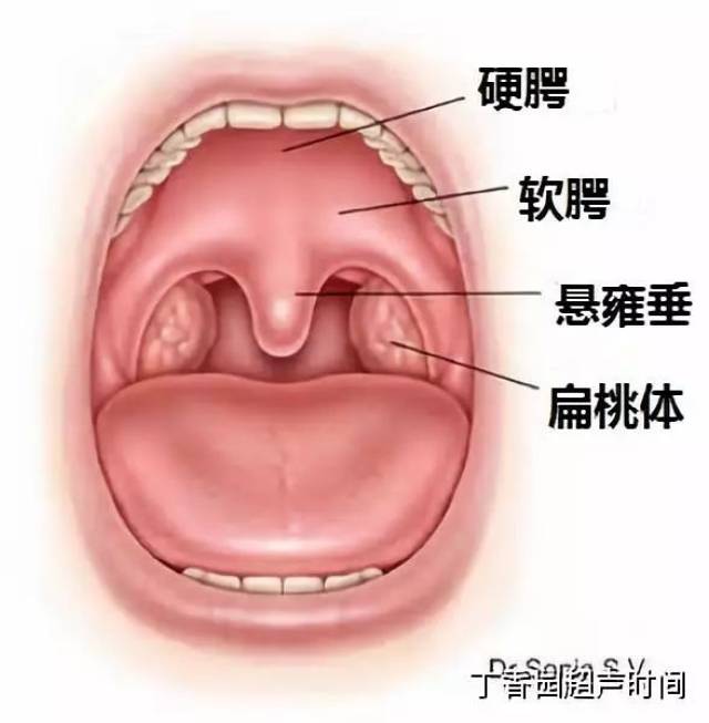 软腭完全裂开伴有部分硬腭裂,但牙槽突常完整.本型也无左右之分.