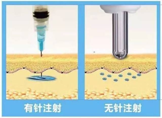 看完无针胰岛素注射器的优点和缺点,再决定是否购买