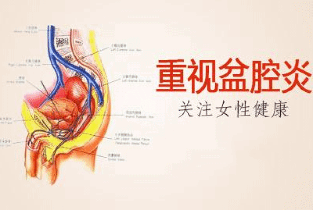 盆腔炎典型的4大症状,汪桂兰医师说:女性要注意了,尤其是第3点!