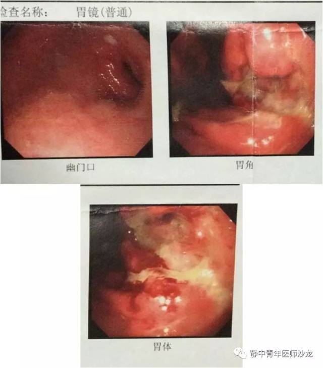 原创全胃切除后反流性食管炎一例