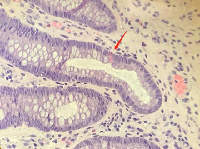 横结肠活检:隐窝结构异常,有分支,萎缩等,隐窝基底部可见潘氏细胞