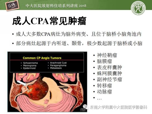 【2018住培系列讲座 第41期】成人桥小脑角区占位性病变影像诊断思路
