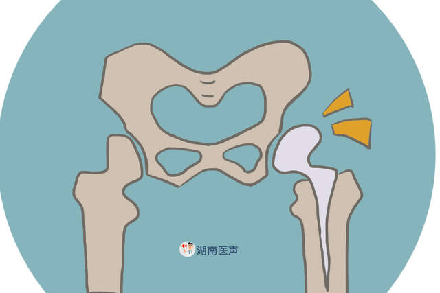 看见孙子"喜极而泣,60岁奶奶一个下蹲竟关节脱位!