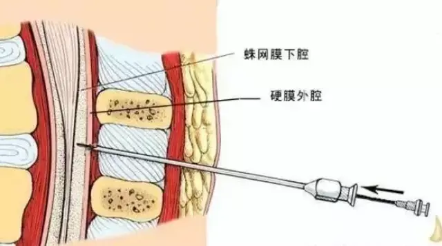 关于麻醉问题