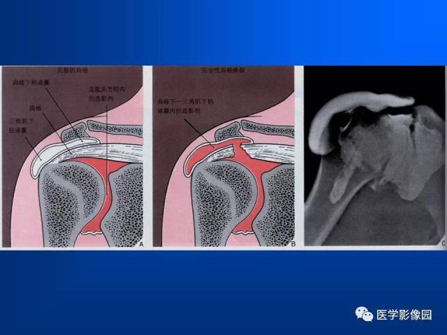肩袖损伤mri诊断 | 影像天地
