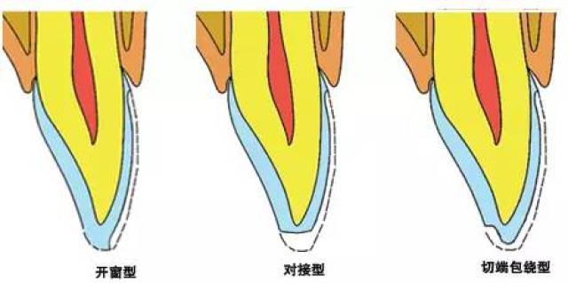 牙科医生必备技能:贴面备牙