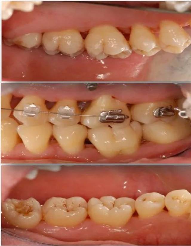 成人慢性牙周炎系统性治疗一例 | 以菌斑控制为导向的
