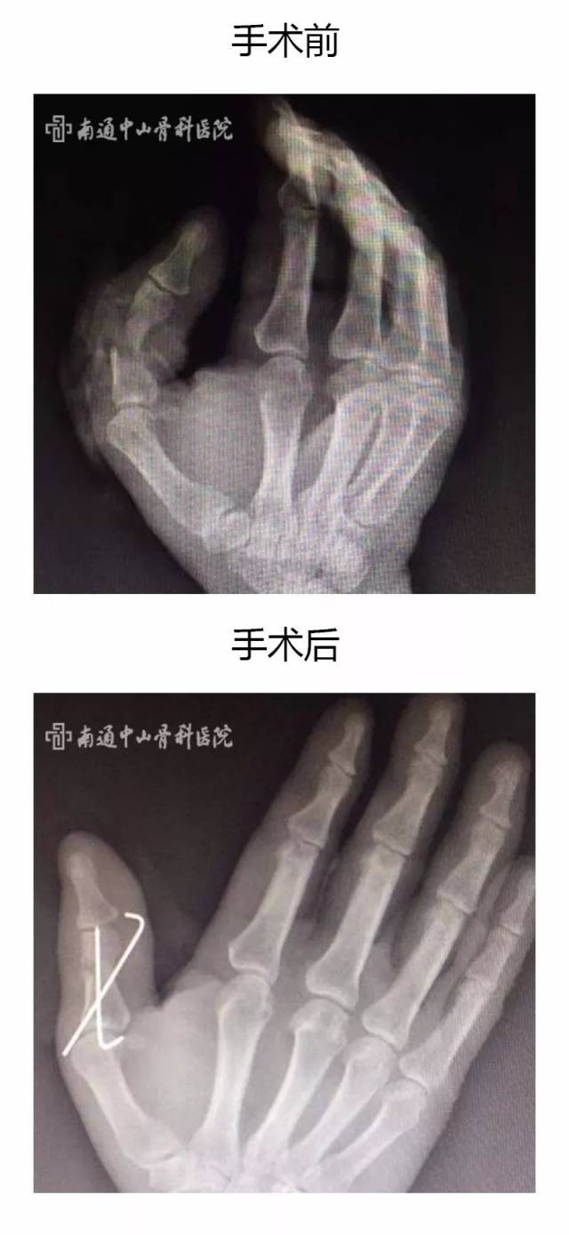 断指再植成功,患者由悲转喜