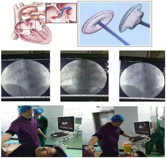 界首市人民医院心内科成功开展微创房间隔缺损封堵术