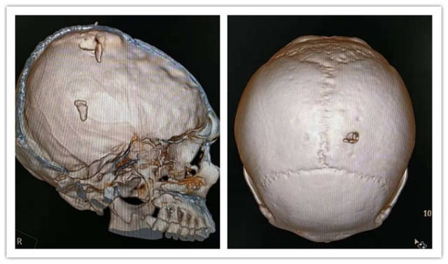 病例分享:急诊开颅手术拯救一位重型开放性颅脑损伤患者