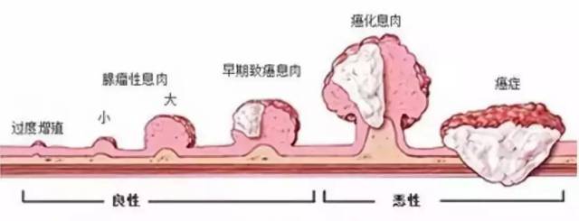 息肉容易变癌,癌多是"拖"出来的