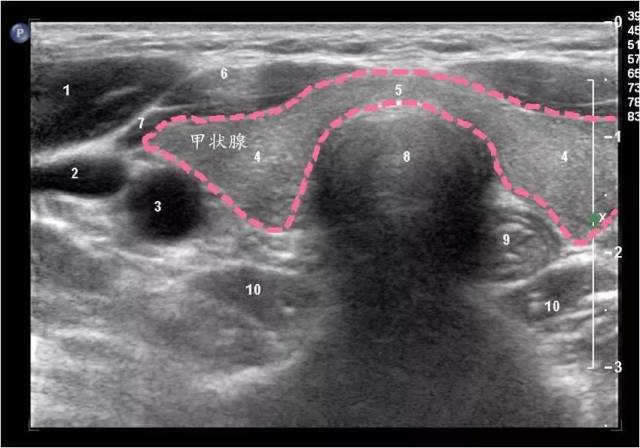 教你正确解读甲状腺超声的7种常见影像