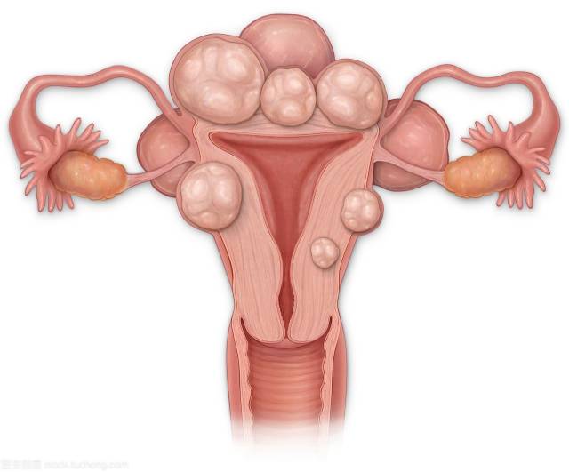女人子宫肌瘤子宫囊肿为什么这么多?原来是它惹的祸