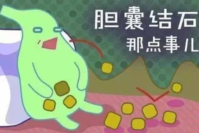 胆囊结石