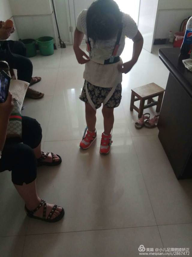 儿童内八字步容易引起跑步摔跤,内八字脚矫正一定要趁早.