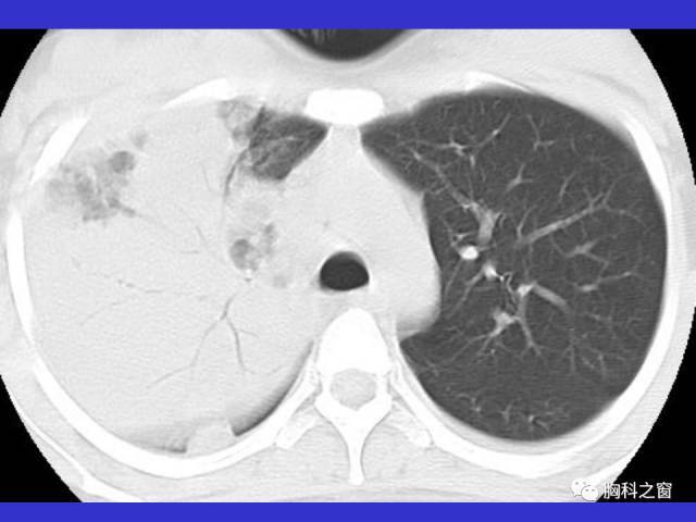 常见肺部感染性疾病ct诊断-心胸医学影像论坛