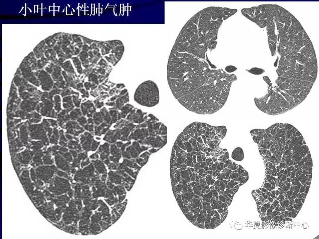 带你了解肺气肿的影像学分型及诊断