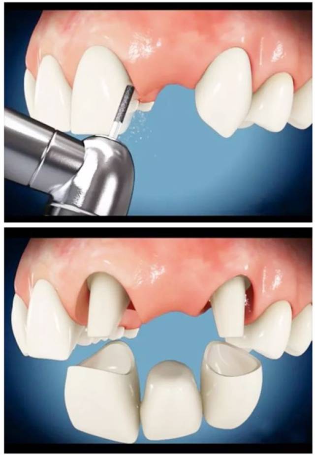 2缺牙的情况不同,镶牙的方式也不同
