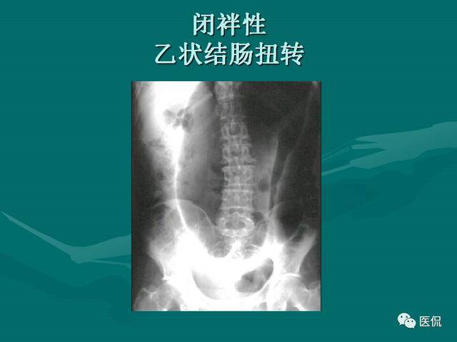 肠梗阻的影像分类及征象 医学影像经典ppt