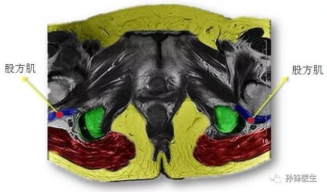 医学笔记|锋哥教你读盆腔核磁共振(4):经女性耻骨联合