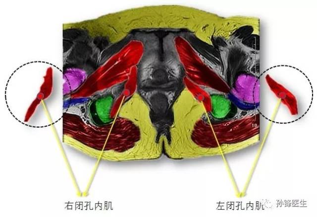 还有一个规律我们可以参考——闭孔内肌和闭孔外肌也往往会同时"出现"